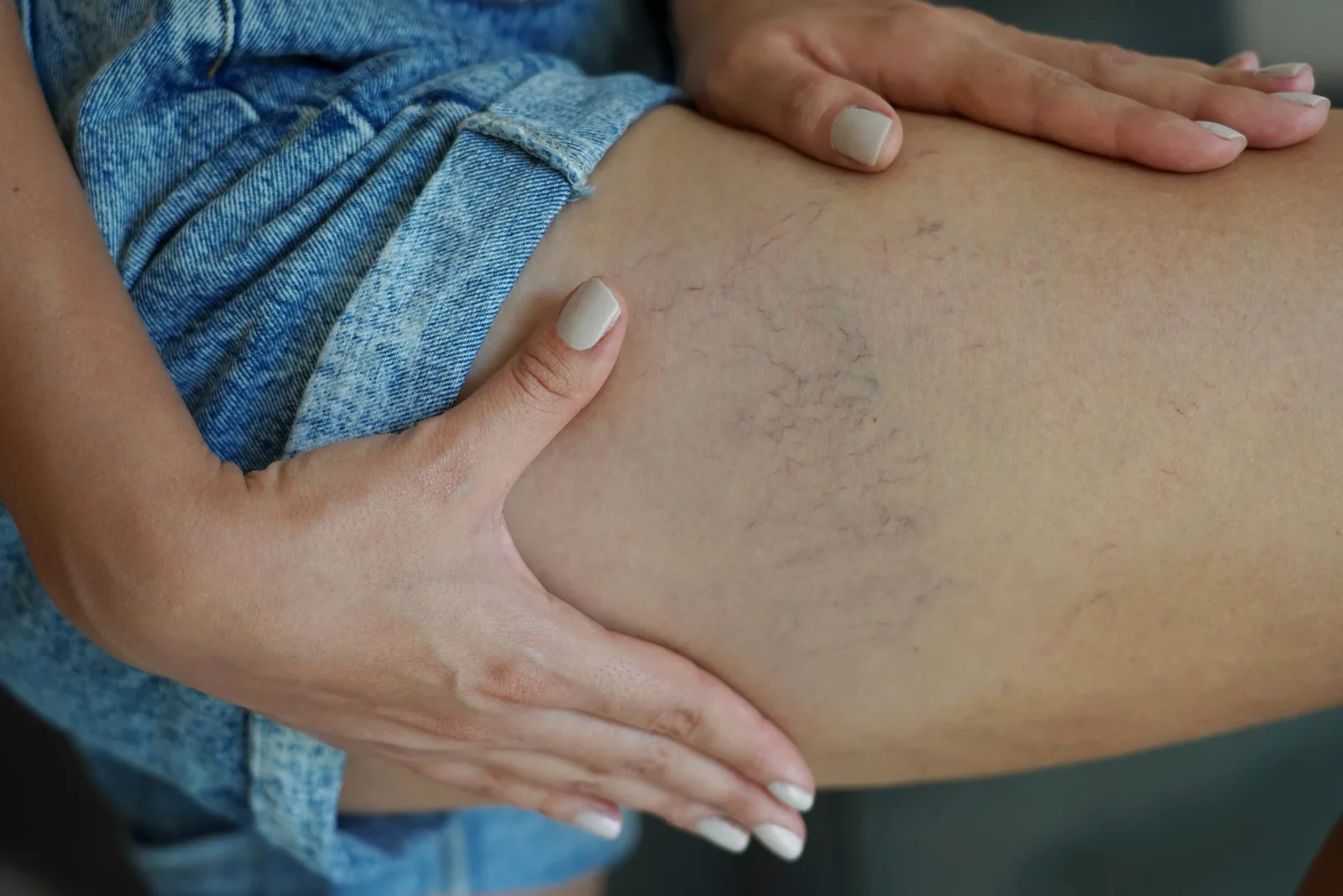Can Thread Veins Be Removed?