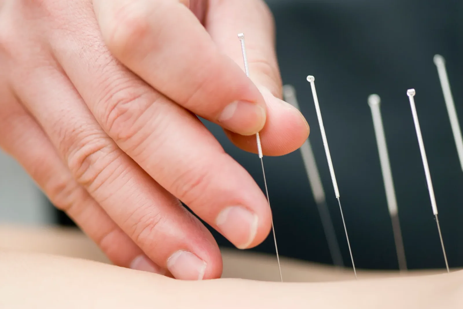 Can Acupuncture Help with Chronic Venous Insufficiency?