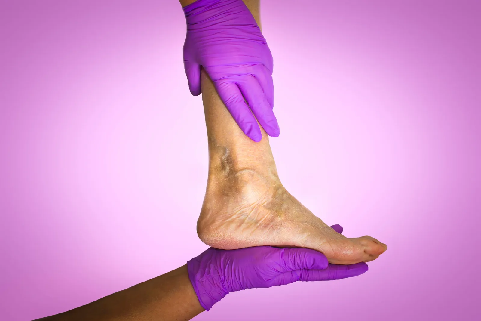 Chronic Venous Insufficiency Treatment Guidelines