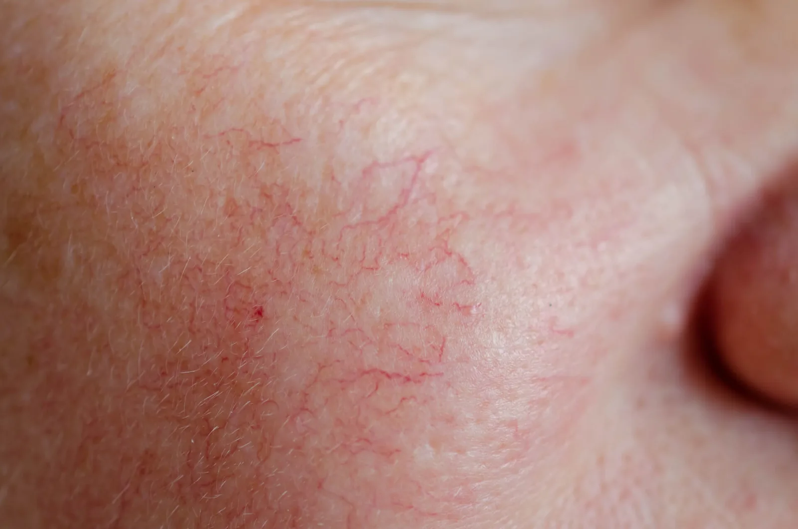 What Causes Spider Veins On Face And How To Treat Them