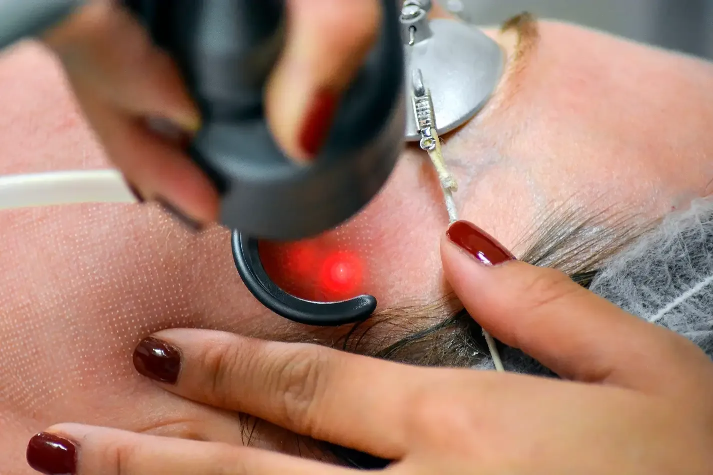 Can Laser Clear Away Facial Thread Veins?