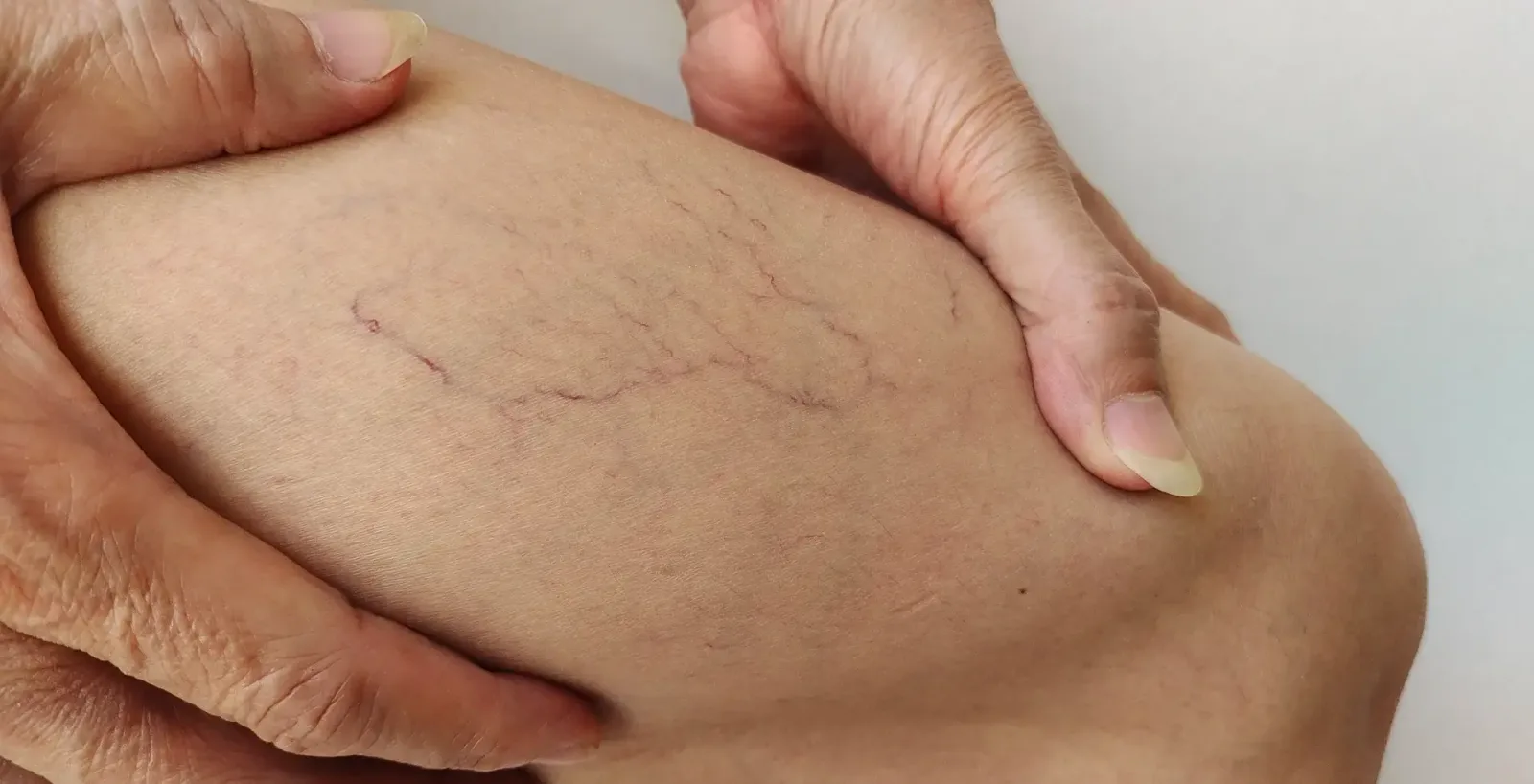 That Red Bump with Spider Veins: A Guide for NY & NJ
