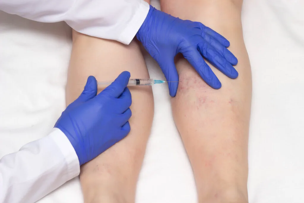 professional vein doctor performing sclerotherapy on a woman's leg which has varicose veins