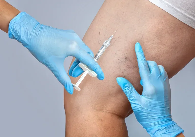 Injection to spider veins in leg