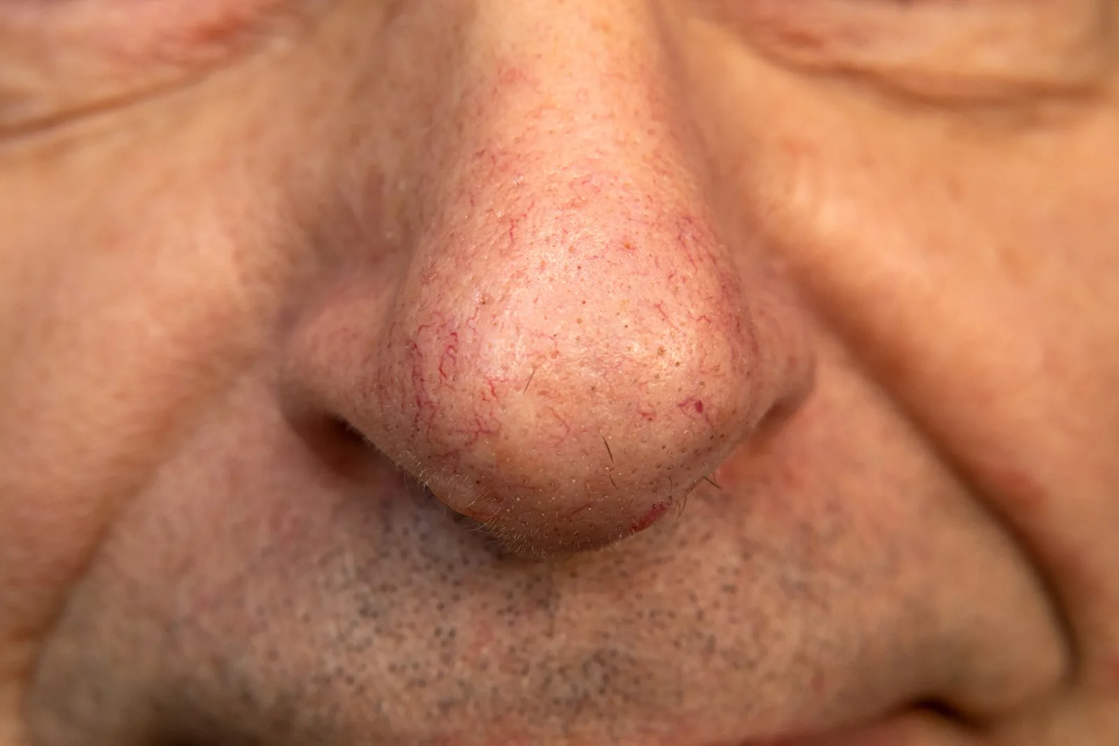 Thread Veins on Nose: Understanding Causes and Finding the