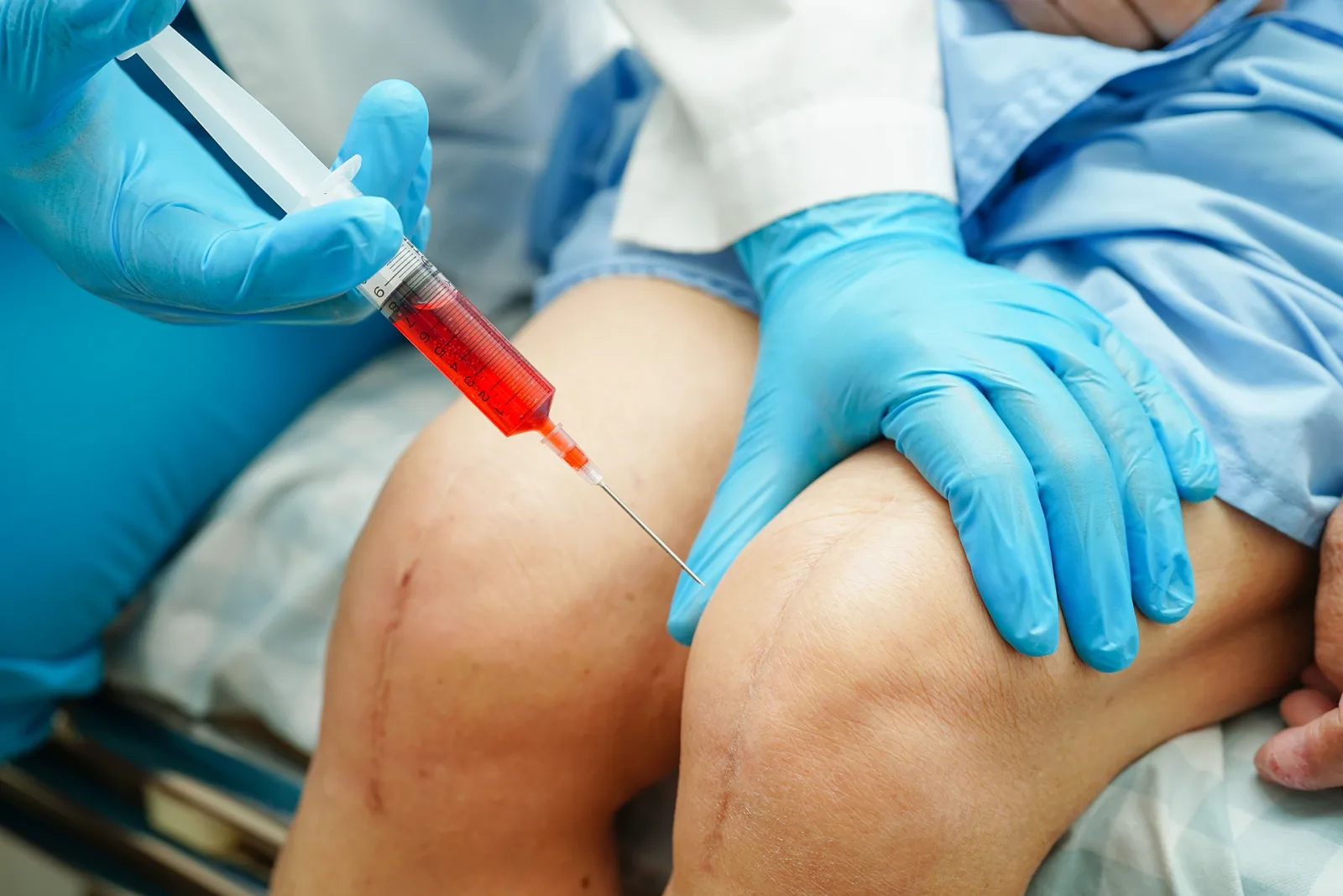 What Happens When a Cortisone Shot Hits Varicose Veins?