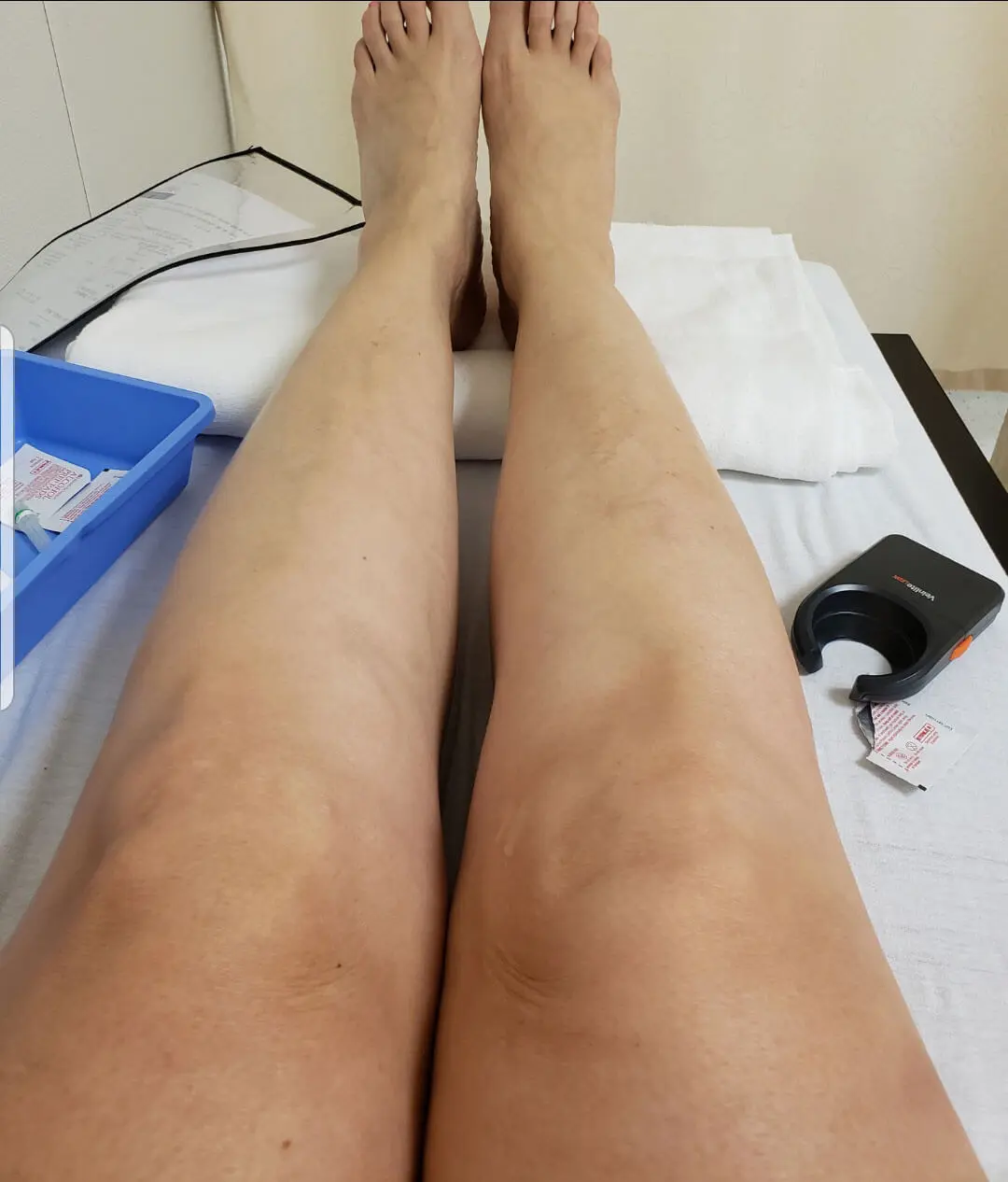 Before and after vein treatment result 5